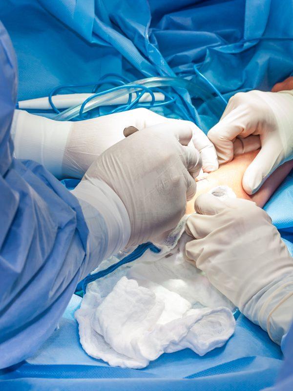 Group Of Surgeons Performing An Elbow Surgery